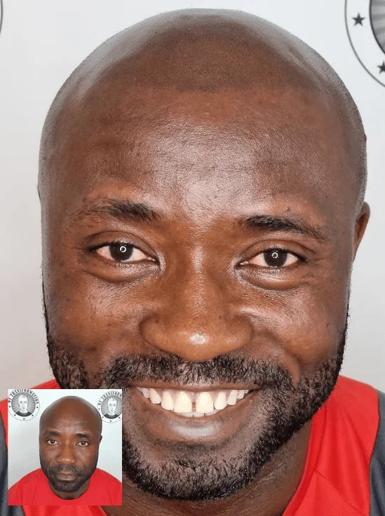 My Transformation, Scalp Micropigmentation Perth, Hair Tattoo Perth, MP Perth, SMP WA, Perth Australia