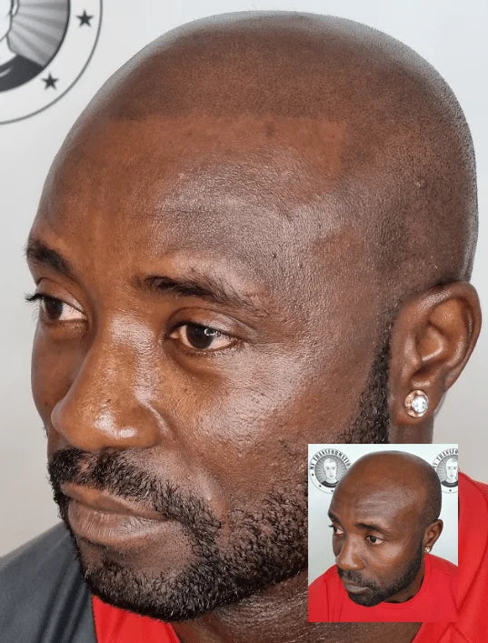 My Transformation, Scalp Micropigmentation Perth, Hair Tattoo Perth, MP Perth, SMP WA, Perth Australia