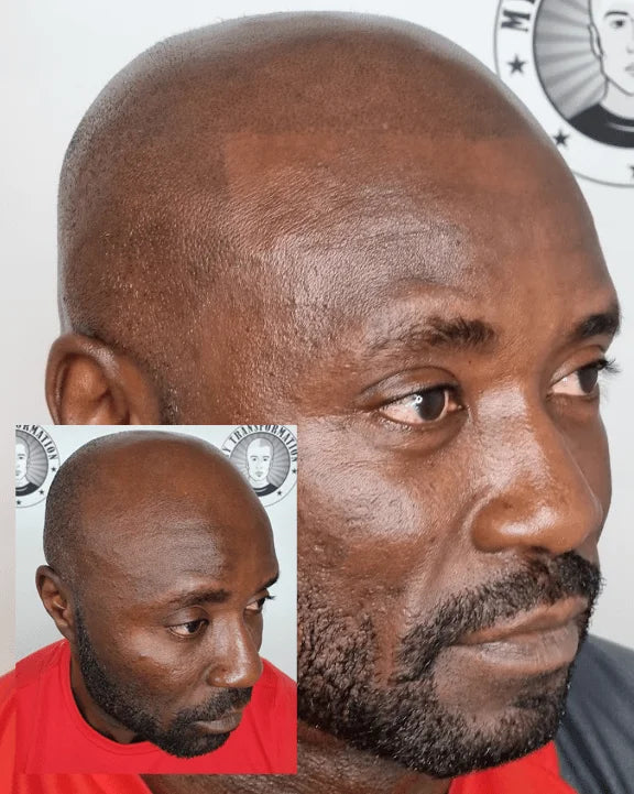 My Transformation, Scalp Micropigmentation Perth, Hair Tattoo Perth, MP Perth, SMP WA, Perth Australia