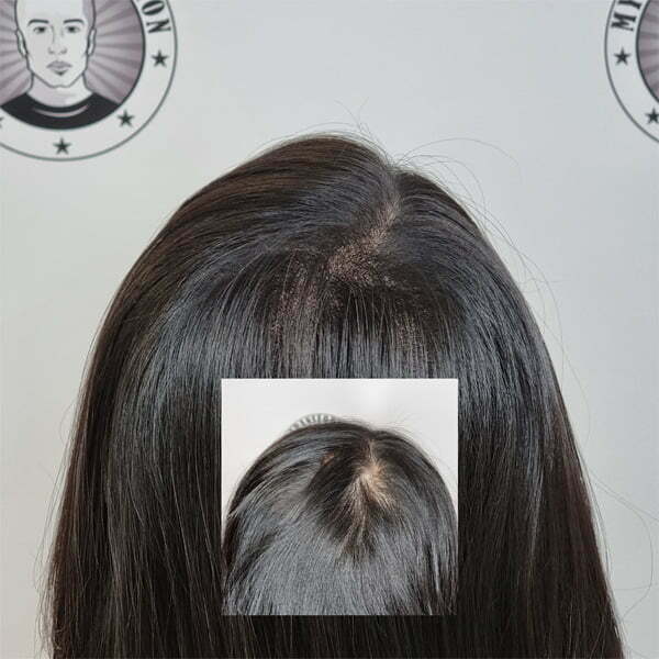 My Transformation, Scalp Micropigmentation Perth, Hair Tattoo Perth, MP Perth, SMP WA, Perth Australia