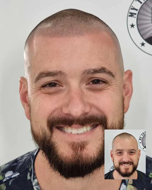 My Transformation | SMP | Hair Tattoo | Scalp micropigmentation | Scalp Micropigmentation Perth | Hairloss | Bald | Ballajura Perth WA