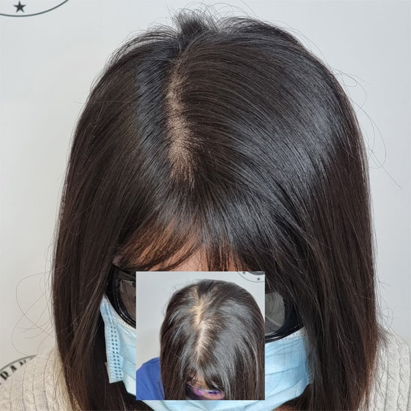 My Transformation, Scalp Micropigmentation Perth, Hair Tattoo Perth, MP Perth, SMP WA, Perth Australia