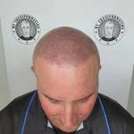 My Transformation, Scalp Micropigmentation Perth, Hair Tattoo Perth, SMP Perth, SMP WA, Perth Australia