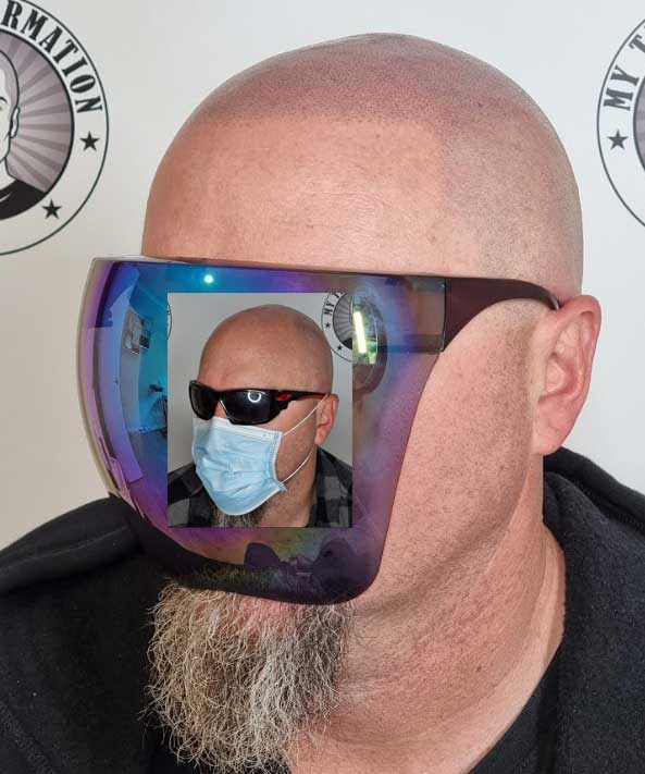 My Transformation, Scalp Micropigmentation Perth, Hair Tattoo Perth, MP Perth, SMP WA, Perth Australia