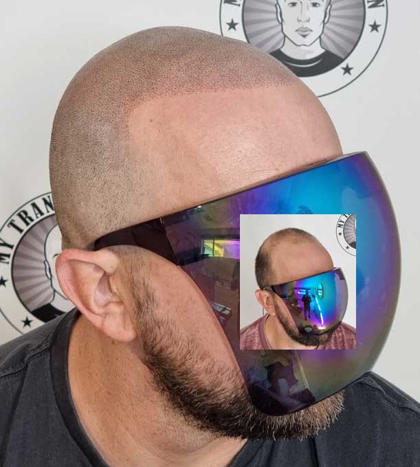 My Transformation, Scalp Micropigmentation Perth, Hair Tattoo Perth, MP Perth, SMP WA, Perth Australia