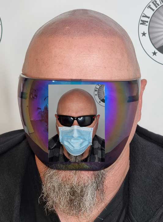 My Transformation, Scalp Micropigmentation Perth, Hair Tattoo Perth, MP Perth, SMP WA, Perth Australia