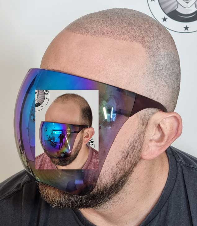 My Transformation, Scalp Micropigmentation Perth, Hair Tattoo Perth, MP Perth, SMP WA, Perth Australia