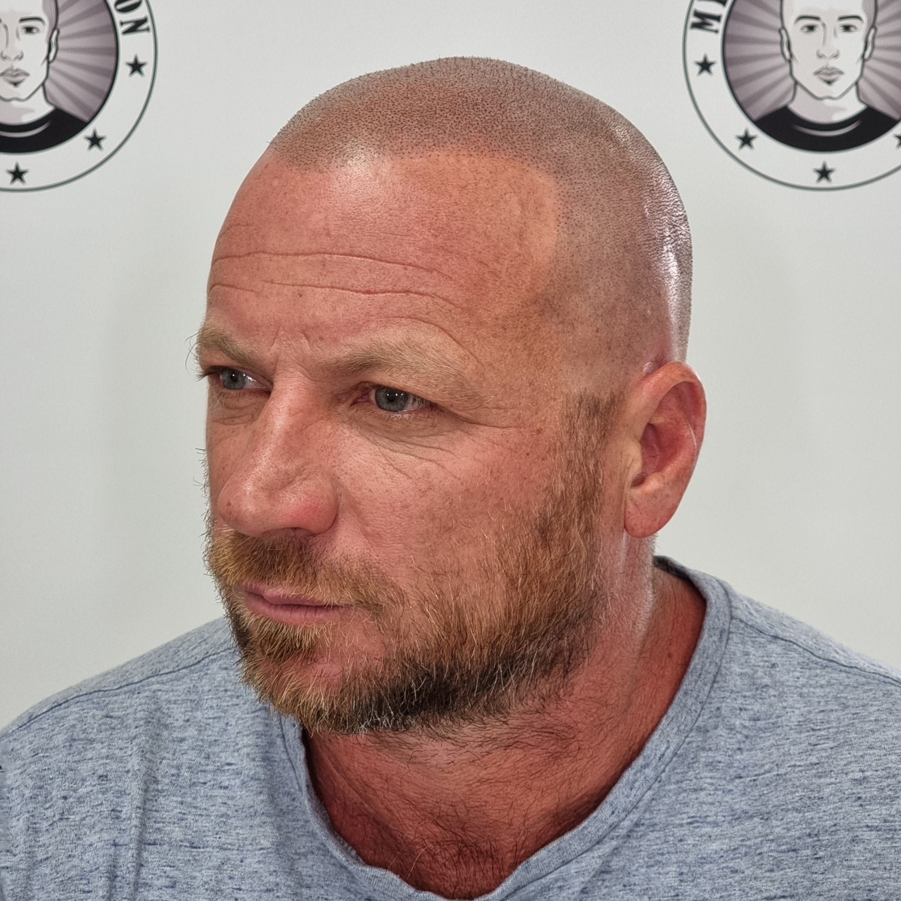 My Transformation, Scalp Micropigmentation Perth, Hair Tattoo Perth, SMP Perth, SMP WA, Perth Australia, Men's hair Tattoo