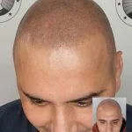 My Transformation, Scalp Micropigmentation Perth, Hair Tattoo Perth, SMP Perth, SMP WA, Perth Australia