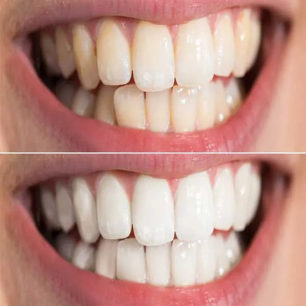 Teeth Whitening Perth - Get a whiter, more confident smile with our professional teeth whitening service. See the improvement straight away, a brighter, whiter smile. Perth, WA Australia