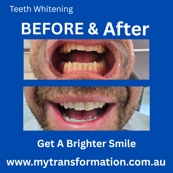 My Transformation, Teeth Witening Perth, Cosmetic Whitening, Instantley A Whiter Smile, Affordable Cosmetic Teeth Whitening,