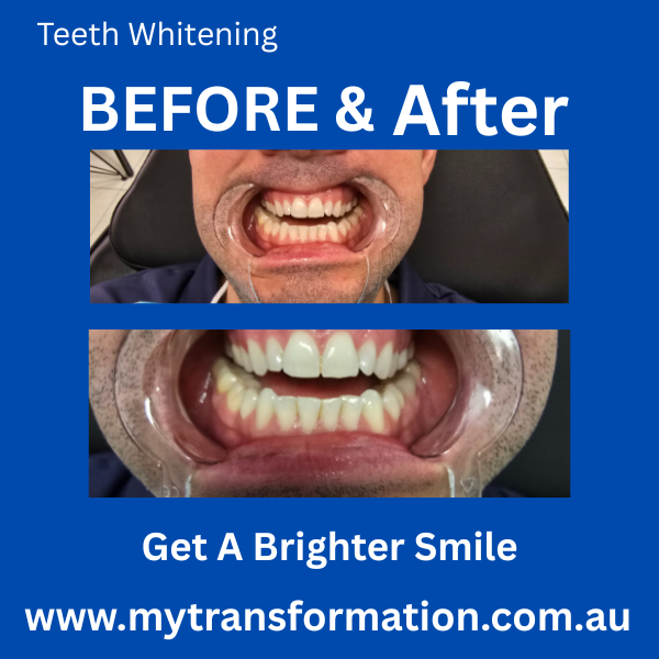 My Transformation, Teeth Witening Perth, Cosmetic Whitening, Instantley A Whiter Smile, Affordable Cosmetic Teeth Whitening,