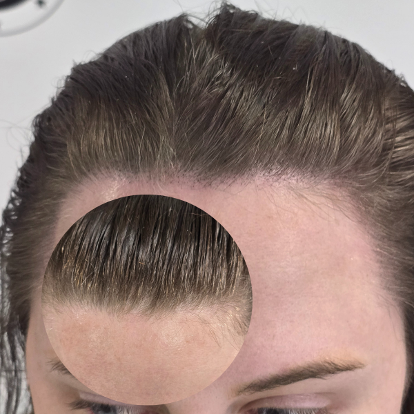 My Transformation,, Women's Hair Tattoo Perth, SMP Perth, SMP WA, Sclp Micropigmentation For Women , Hair Density For Women