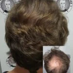 My Transformation, Scalp Micropigmentation Perth, Hair Tattoo Perth, SMP Perth, SMP WA, Perth Australia, Hair Density