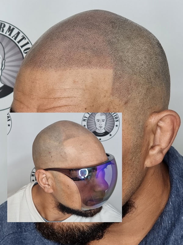 My Transformation, Scalp Micropigmentation Perth, Hair Tattoo Perth, MP Perth, SMP WA, Perth Australia