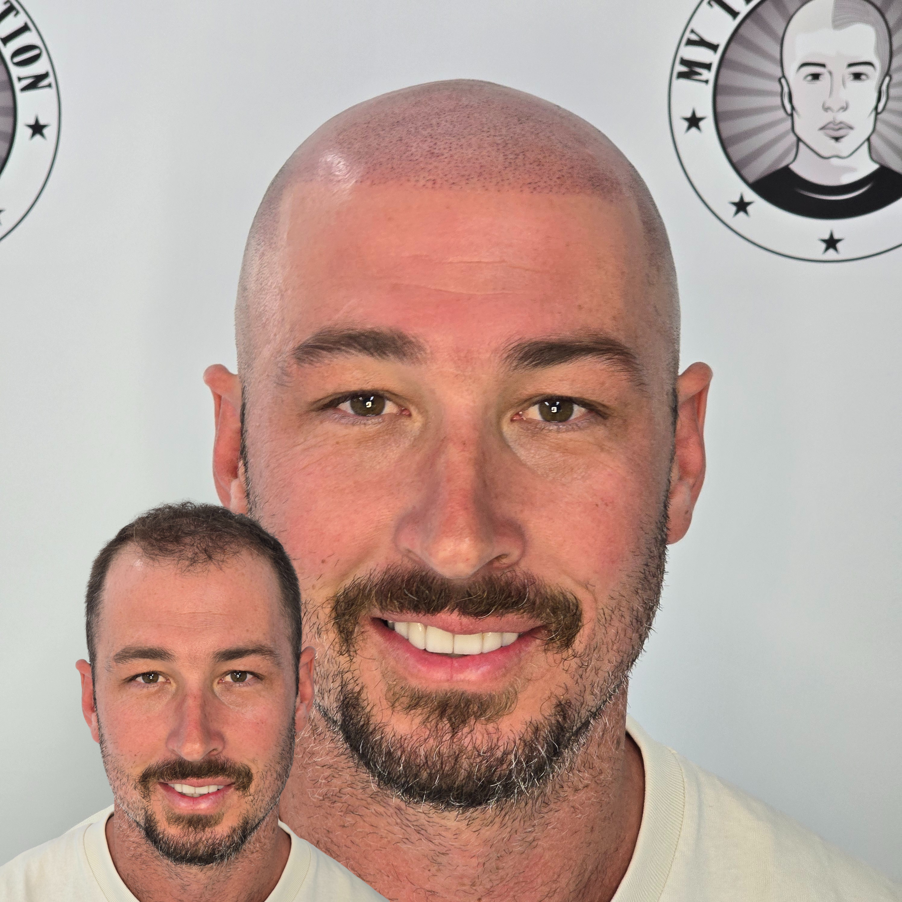 My Transformation, Scalp Micropigmentation Perth, Hair Tattoo Perth, SMP Perth, SMP WA, Perth, Australia, Men's hair Tattoo, SMP in action, Scalp Micropigmentation