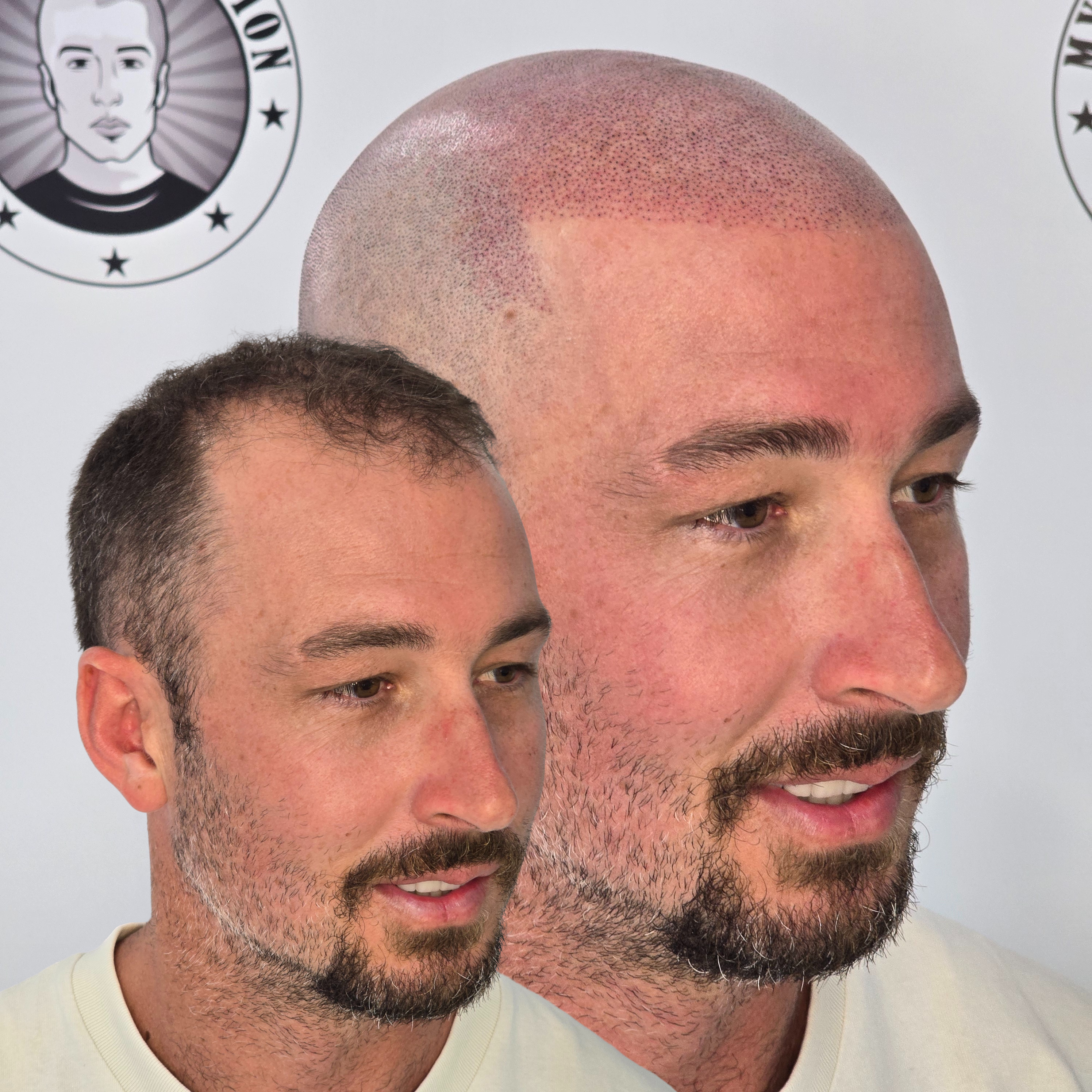 My Transformation, Scalp Micropigmentation Perth, Hair Tattoo Perth, SMP Perth, SMP WA, Perth, Australia, Men's hair Tattoo, SMP in action, Scalp Micropigmentation