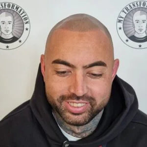 My Transformation, Scalp Micropigmentation Perth, Hair Tattoo Perth, SMP Perth, SMP WA, Perth Australia, Men's hair Tattoo