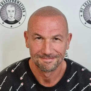 My Transformation, Scalp Micropigmentation Perth, Hair Tattoo Perth, SMP Perth, SMP WA, Perth Australia, Men's hair Tattoo