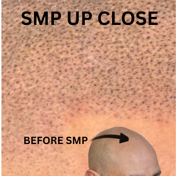 My Transformation, Scalp Micropigmentation Perth, Hair Tattoo Perth, SMP Perth, SMP WA, Perth, Australia, Men's hair Tattoo, SMP in action, Scalp Micropigmentation