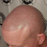 My Transformation, Scalp Micropigmentation Perth, Hair Tattoo Perth, SMP Perth, SMP WA, Perth Australia