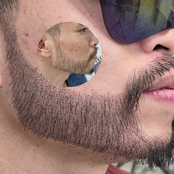 My Transformation, Beard Micropigmentation Perth, Hair Tattoo Perth, SMP Perth, SMP WA, Beard Tattoo