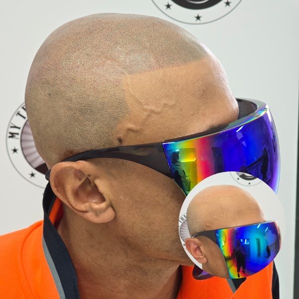 My Transformation, Scalp Micropigmentation Perth, Hair Tattoo Perth, SMP Perth, SMP WA, Perth Australia, Men's hair Tattoo, Session 3 Scalp Micropigmentation