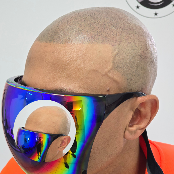 My Transformation, Scalp Micropigmentation Perth, Hair Tattoo Perth, SMP Perth, SMP WA, Perth Australia, Men's hair Tattoo, Session 3 Scalp Micropigmentation