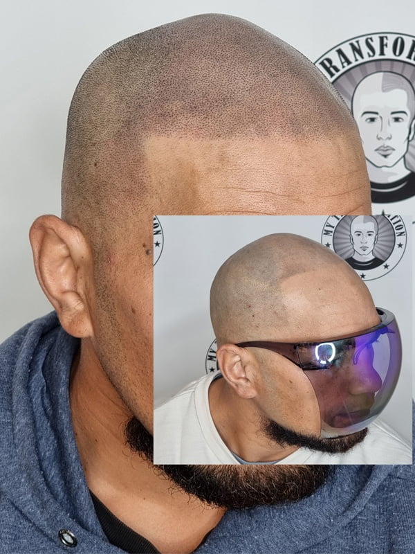 My Transformation, Scalp Micropigmentation Perth, Hair Tattoo Perth, MP Perth, SMP WA, Perth Australia