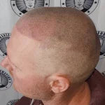 My Transformation, Scalp Micropigmentation Perth, Hair Tattoo Perth, SMP Perth, SMP WA, Perth Australia, Video of SMP & Testimonials