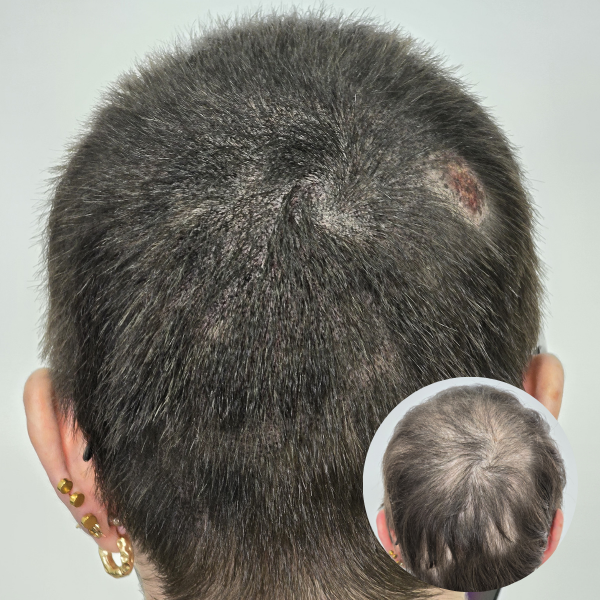 My Transformation,, Women's Hair Tattoo Perth, SMP Perth, SMP WA, Sclp Micropigmentation For Women , Hair Density For Women