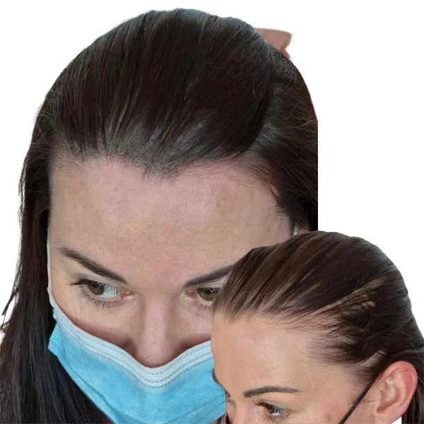 Hair Tattoo for Women - Regain your confidence back with Scalp Micropigmentation / Hair tattoo the best way to combat your hair loss.  Perth, WA Australia.