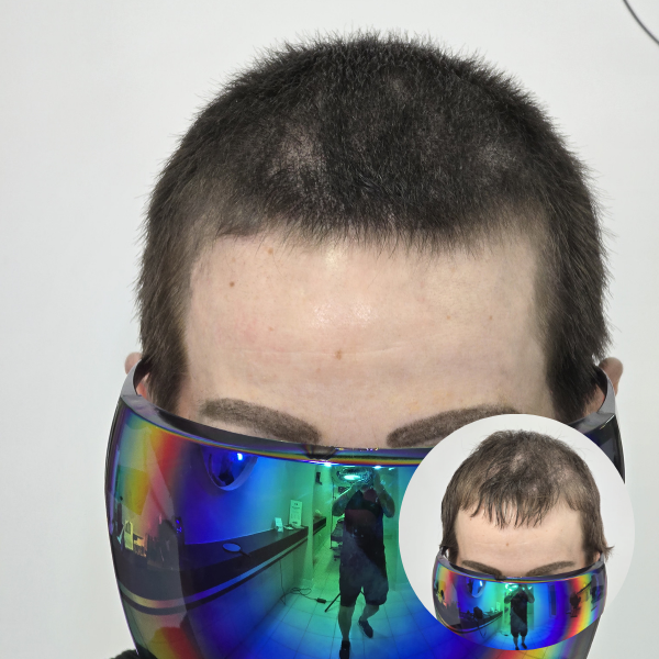 My Transformation,, Women's Hair Tattoo Perth, SMP Perth, SMP WA, Sclp Micropigmentation For Women , Hair Density For Women