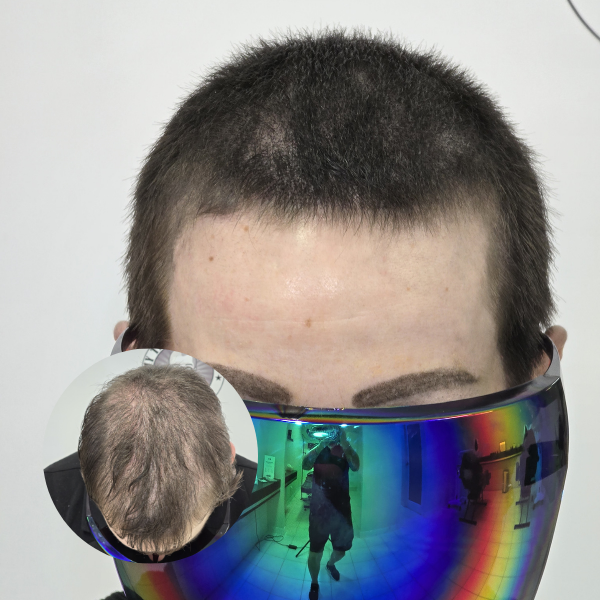 My Transformation,, Women's Hair Tattoo Perth, SMP Perth, SMP WA, Sclp Micropigmentation For Women , Hair Density For Women