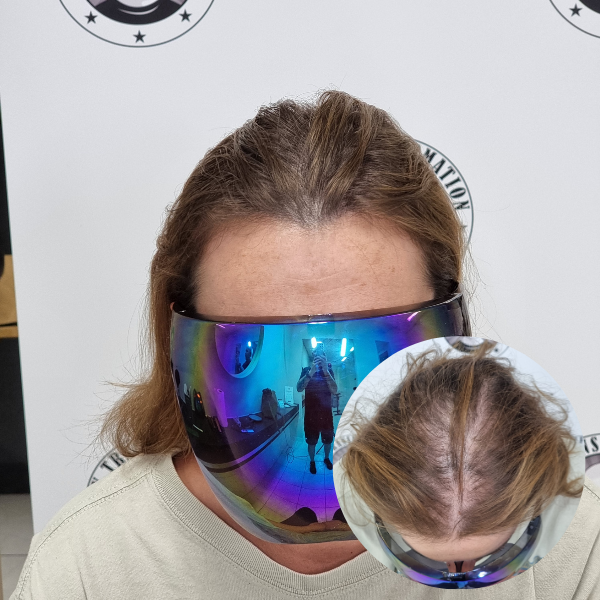 My Transformation, Scalp Micropigmentation Perth, Women's Hair Tattoo Perth, SMP Perth, SMP WA, Perth Australia
